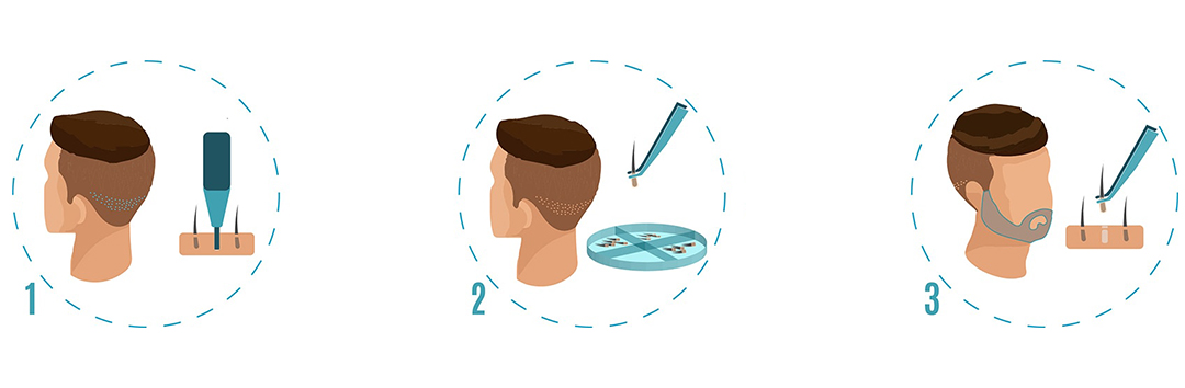 fasi del trapianto di barba con tecnica FUE