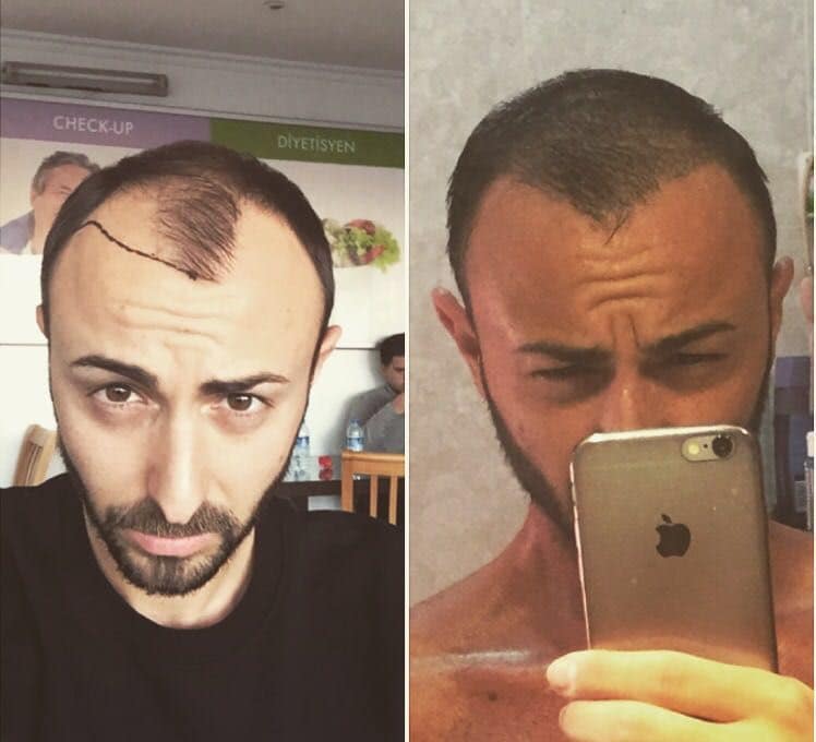 prima e dopo trapianto capelli 10