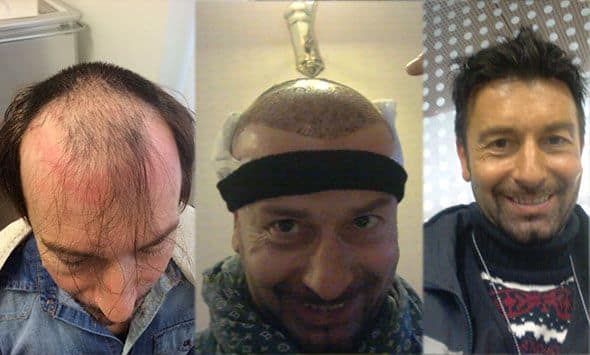 prima e dopo trapianto capelli 28